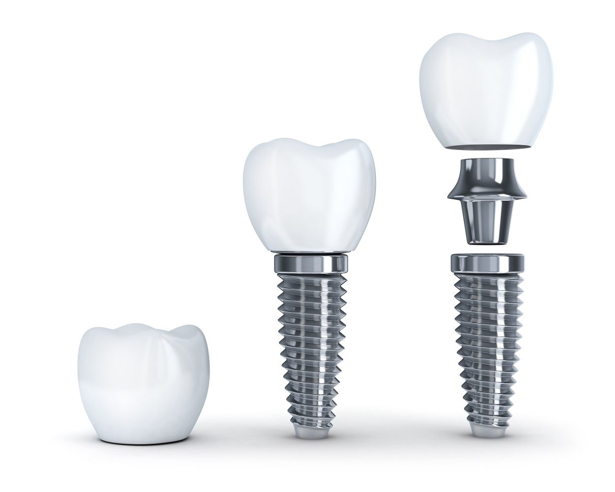 Dental implant placement in Chislehurst
